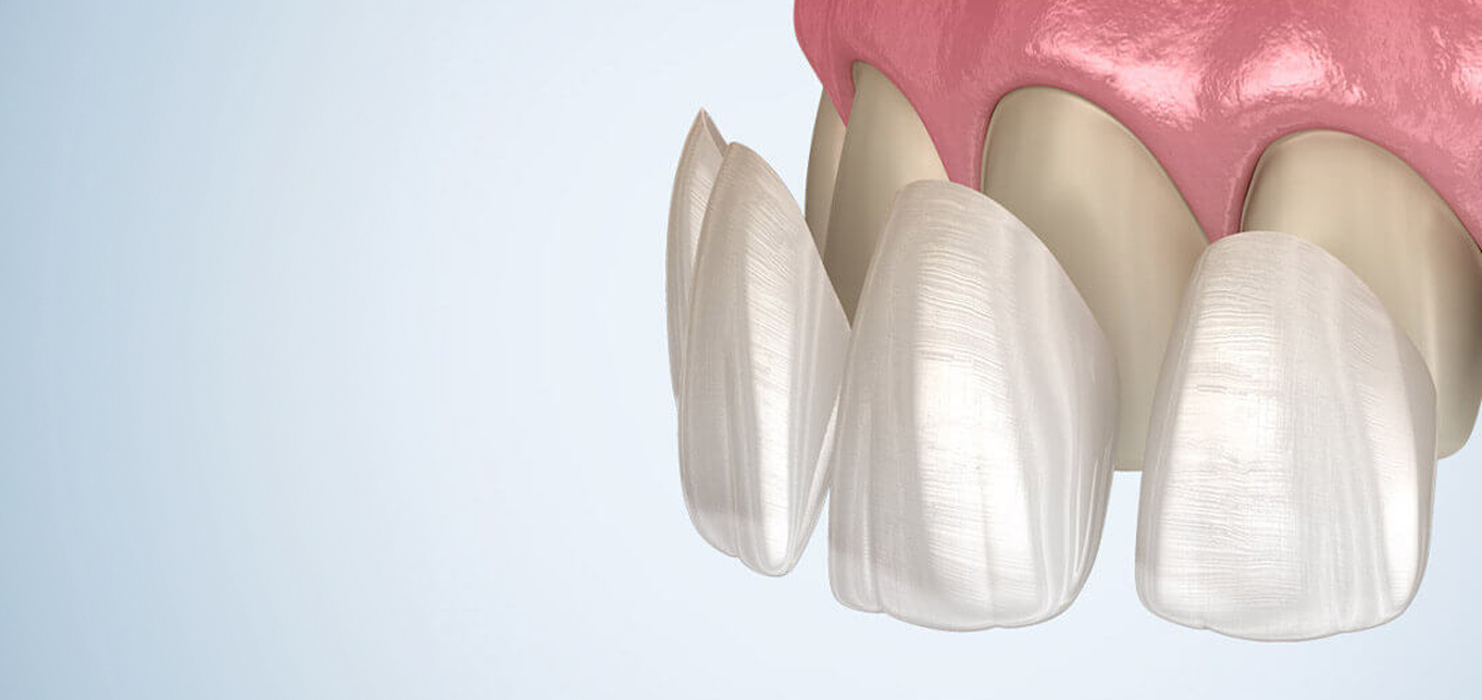 3-reasons-to-consider-ceramic-veneers-why-they-re-worth-considering