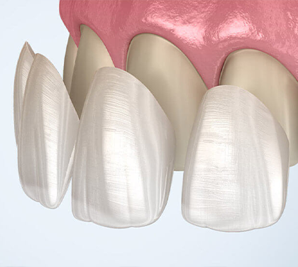 3-reasons-to-consider-ceramic-veneers-why-they-re-worth-considering