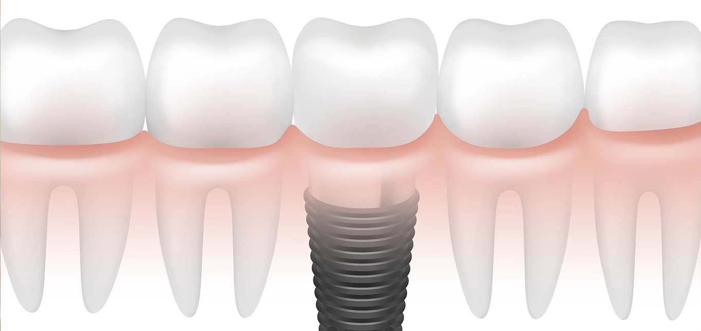 are-dental-implants-right-for-you-an-expert-guide