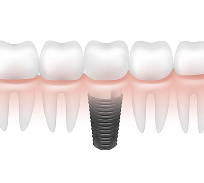 are-dental-implants-right-for-you-an-expert-guide