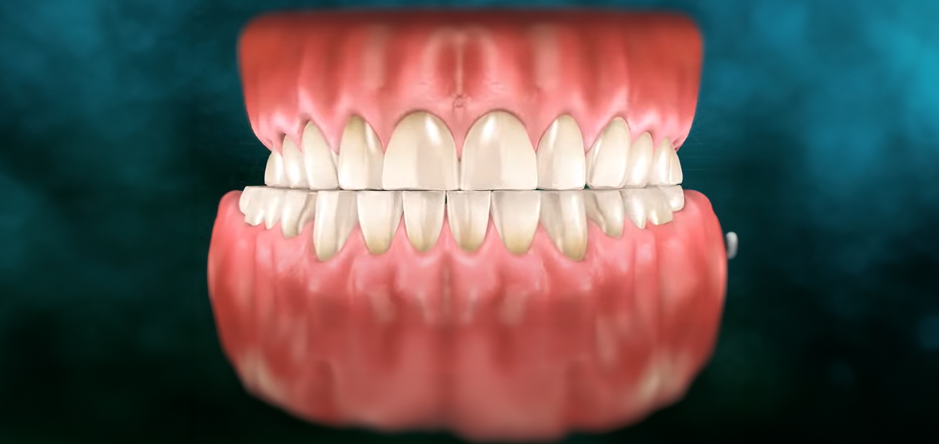 bruxism-teeth-grinding-causes-effects-and-treatment-options