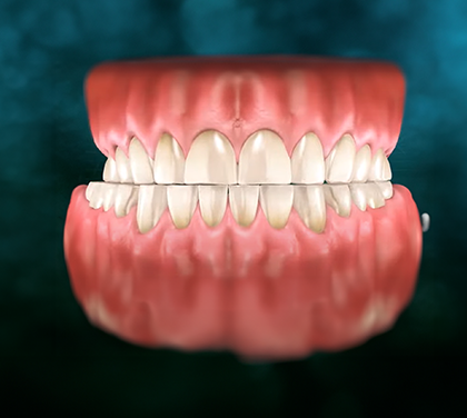 bruxism-teeth-grinding-causes-effects-and-treatment-options