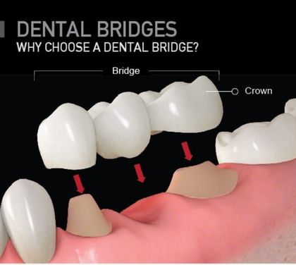 dental-bridges-replacing-your-teeth-with-the-right-way