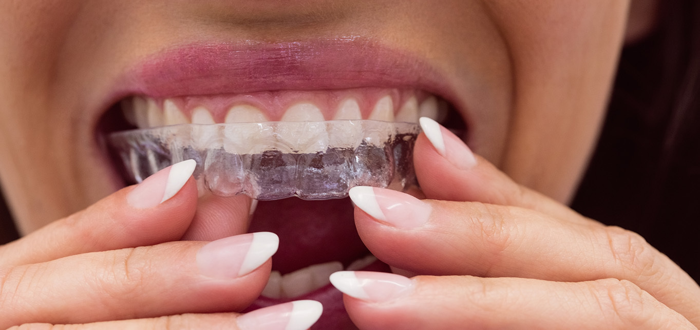 invisalign-treatment-the-clear-choice-for-orthodontic-treatment