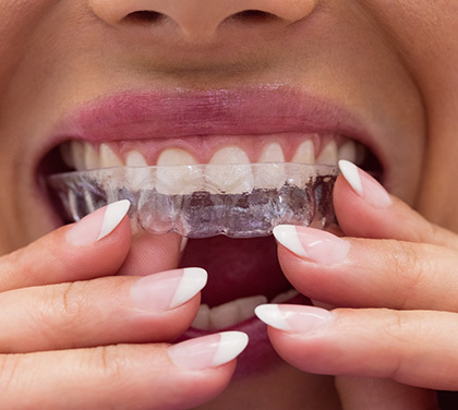 invisalign-treatment-the-clear-choice-for-orthodontic-treatment