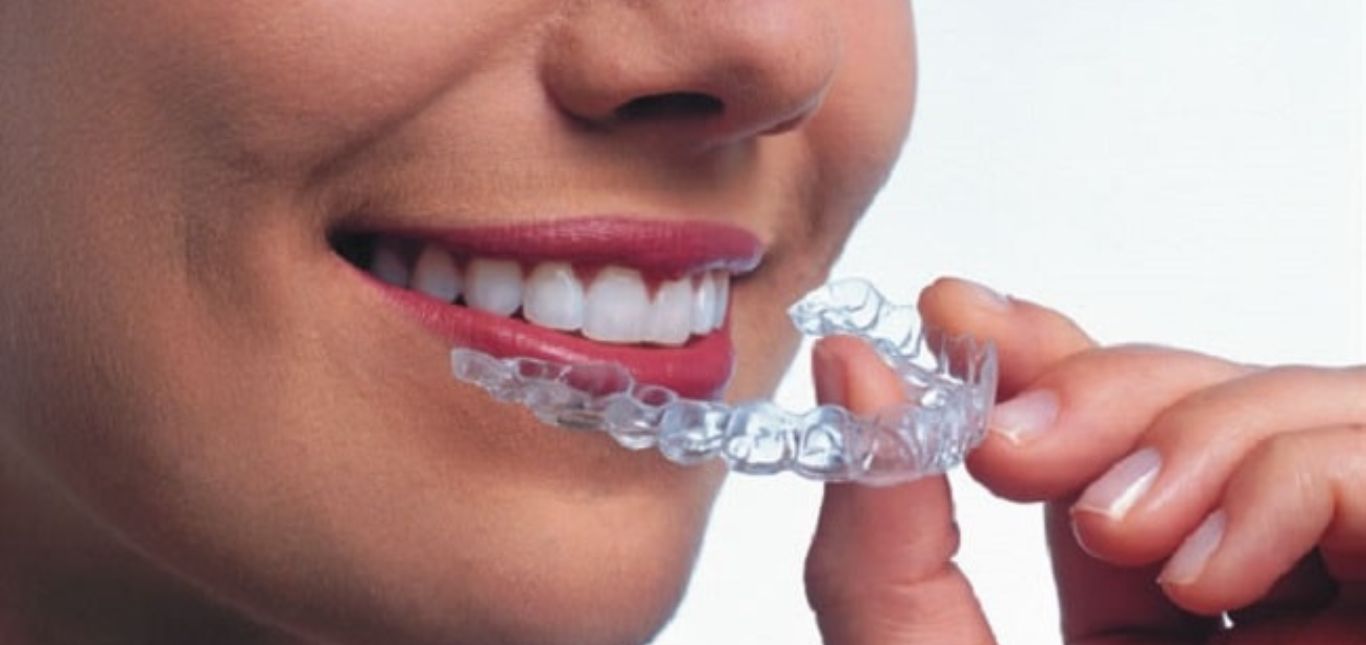 pieces-of-advice-when-wearing-dental-braces
