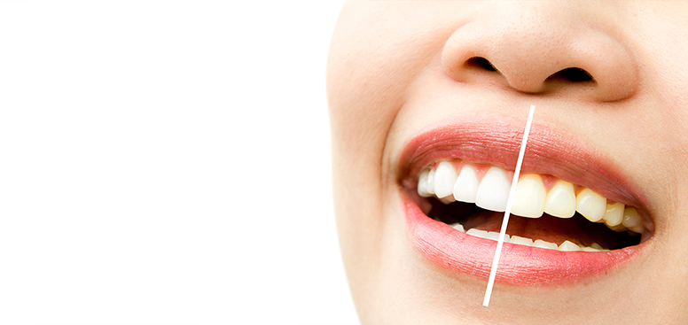 teeth-whitening-options-what-works-best-for-your-smile