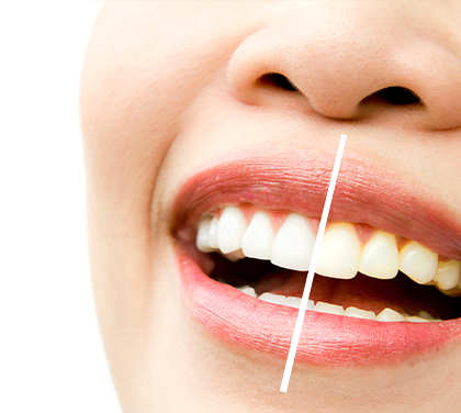 teeth-whitening-options-what-works-best-for-your-smile