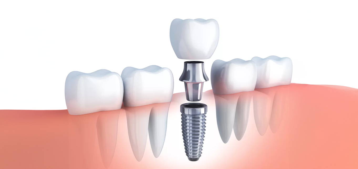 the-impact-of-tooth-extraction-on-your-smile-how-to-restore-lost-teeth