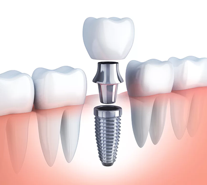 the-impact-of-tooth-extraction-on-your-smile-how-to-restore-lost-teeth