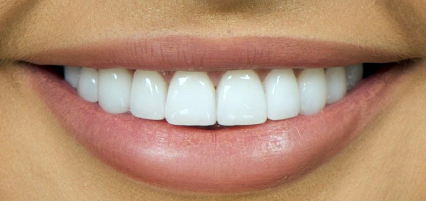 top-5-reasons-people-choose-veneers-for-their-smile-makeover