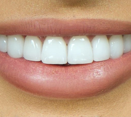 top-5-reasons-people-choose-veneers-for-their-smile-makeover