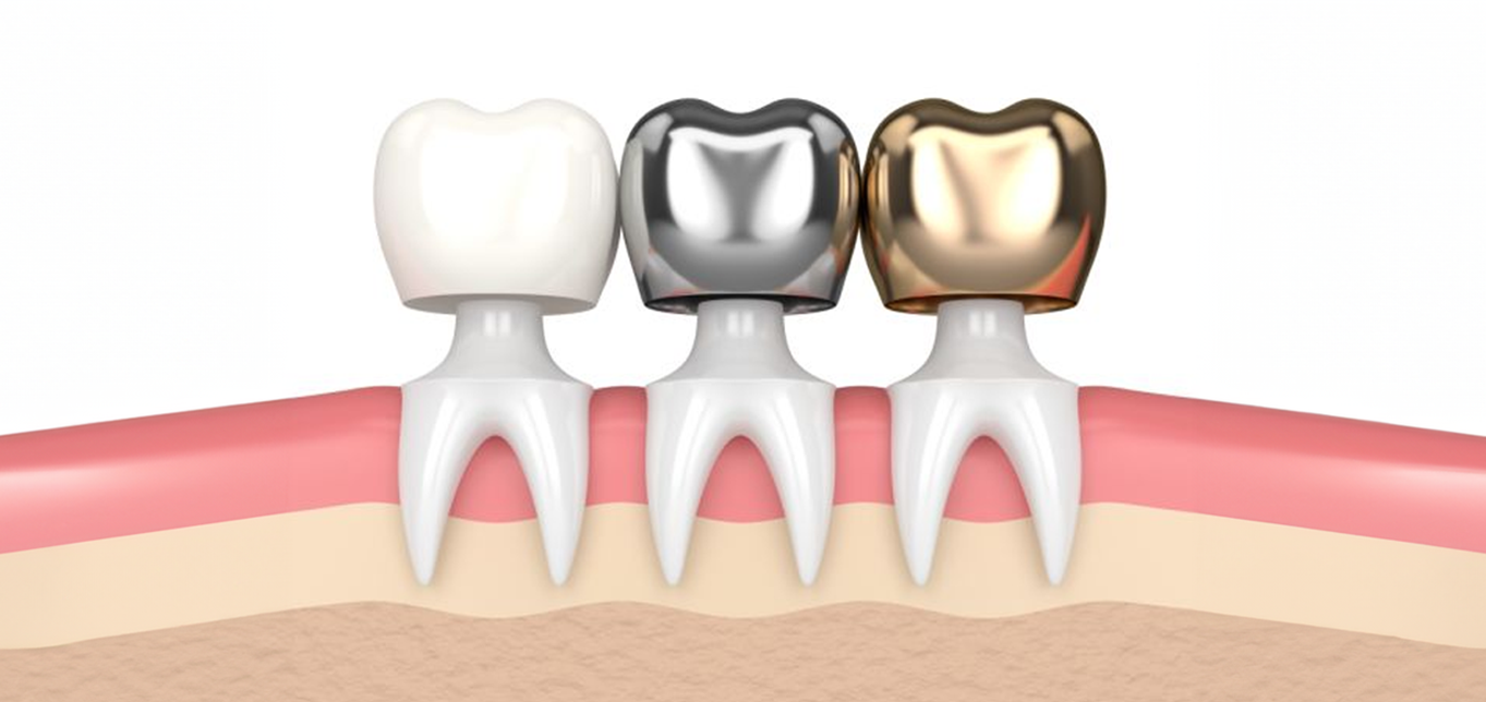 types-of-dental-crowns-and-cost-a-complete-guide-to-2024