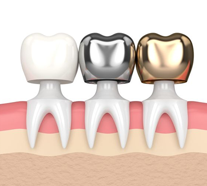 types-of-dental-crowns-and-cost-a-complete-guide-to-2024