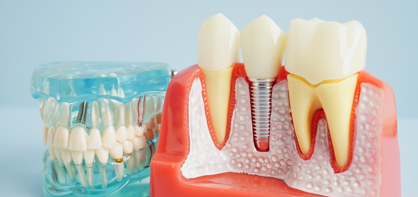 understanding-the-different-types-of-dental-implants