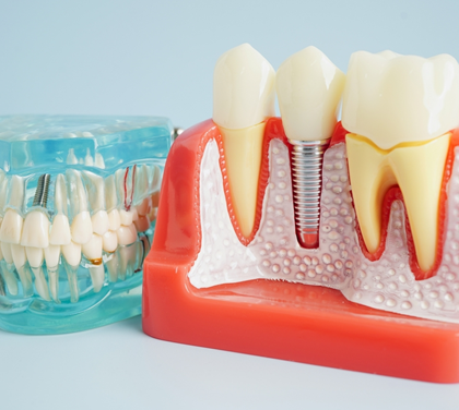 understanding-the-different-types-of-dental-implants