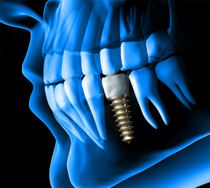 what-is-a-dental-implant-what-are-the-major-advantages-of-this-procedure