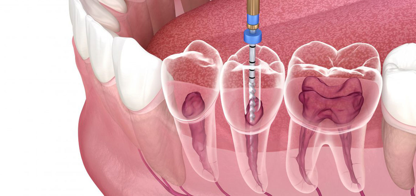 what-steps-are-involved-in-a-root-canal-treatment