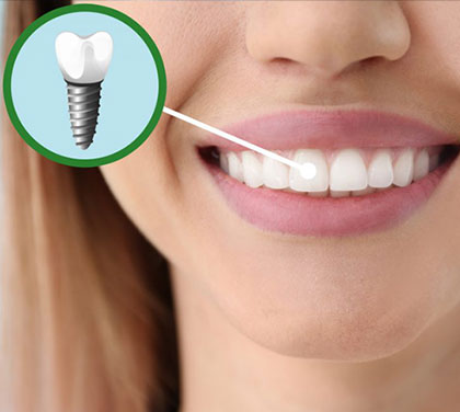 when-should-you-opt-for-dental-implant-treatment