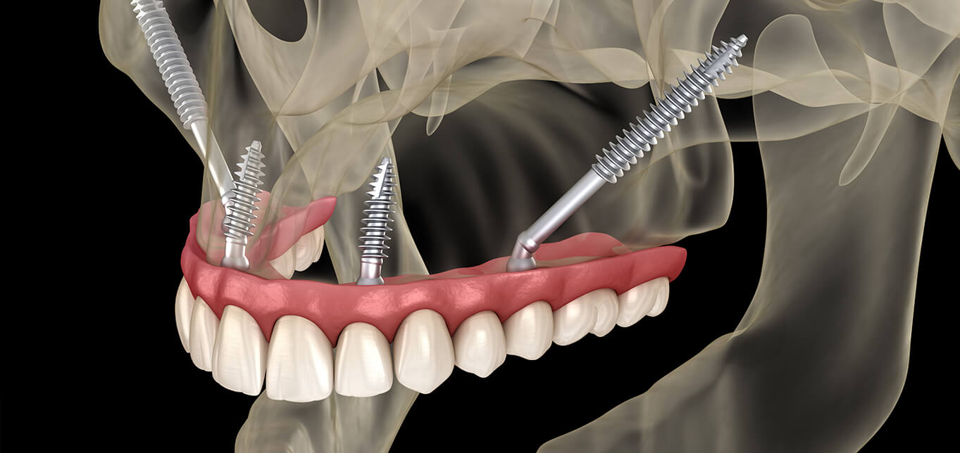 zygomatic-dental-implants