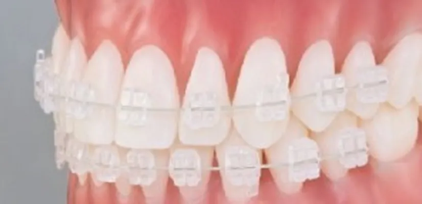 Ceramic Braces