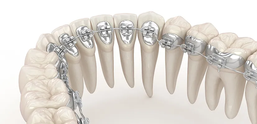 Lingual Braces