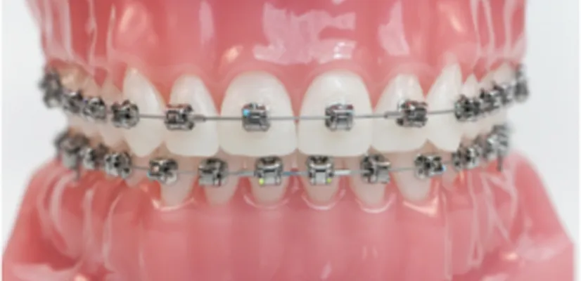 Traditional Metal Braces