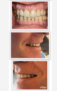 full mouth dental implants in india